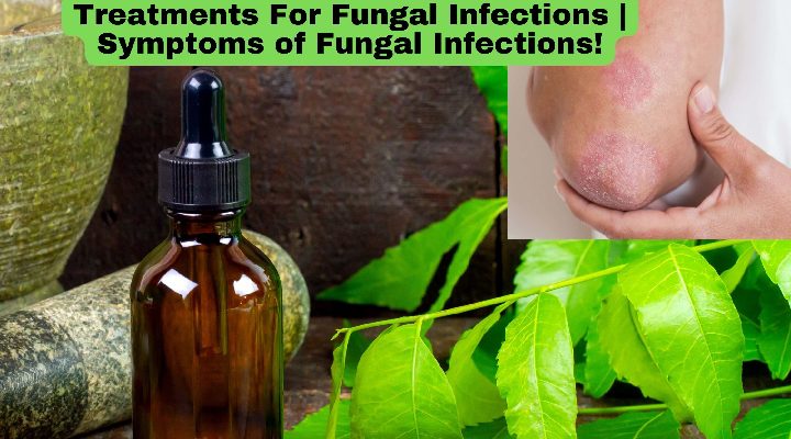 Treatments For Fungal Infections | Symptoms of Fungal Infections